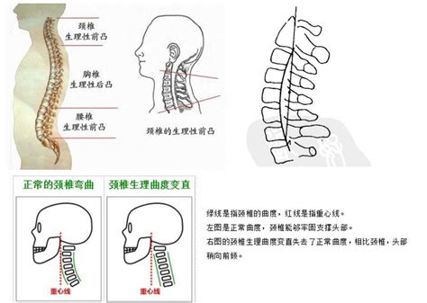 反弓|什么是颈椎反弓？颈椎反弓怎么治疗最好的方法